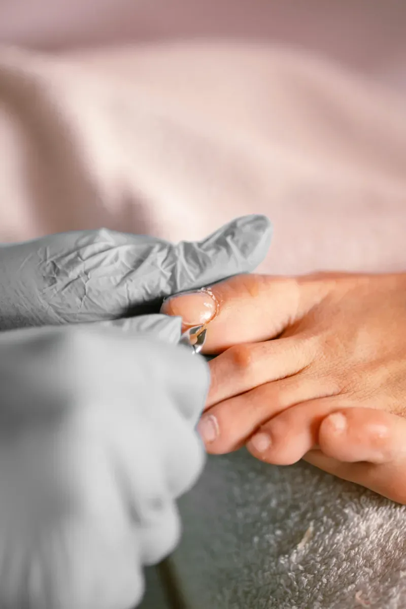 Aanbrengen van een passieve nagelbeugel op een teennagel